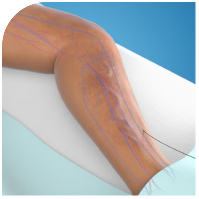 catheter-is-placed-in-the-vein