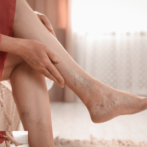 Deep Vein Thrombosis