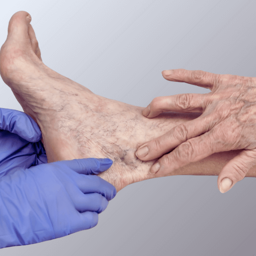 Sclerotherapy