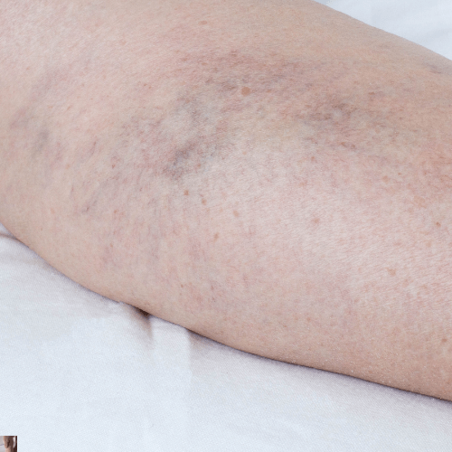 Superficial Vein Thrombosis 2