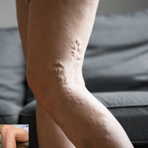 Thrombophlebitis