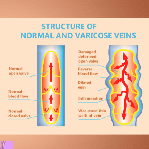 Varicose Veins 1